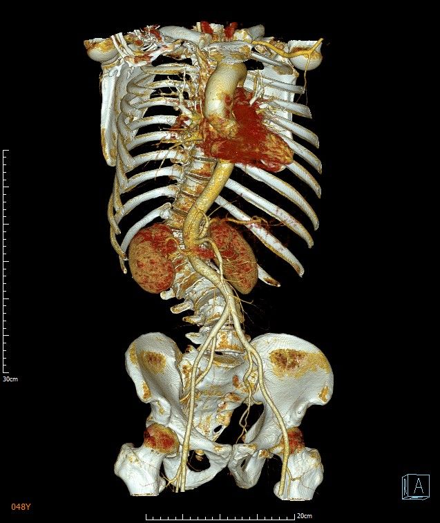 驼背40年后怎样挺直了腰?