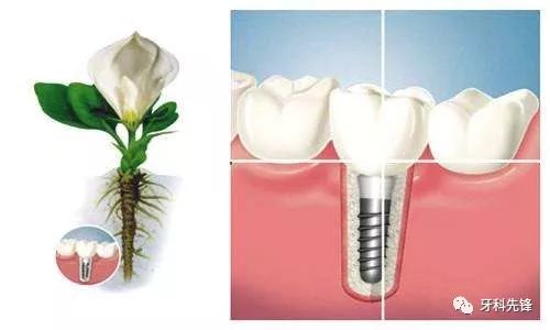 别慌,种植牙其实一点都不可怕!