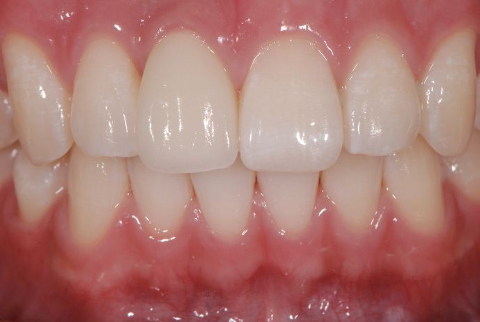 数字化微创前牙美学种植一例