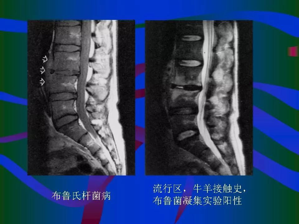 脊柱结核的ct及mri诊断 | 影像天地