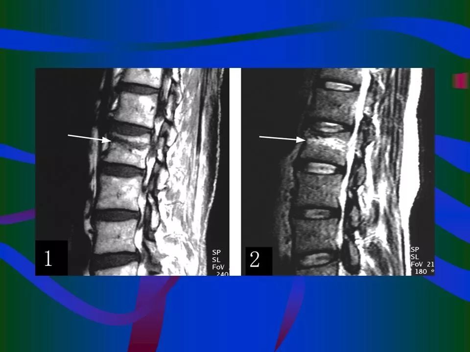 脊柱结核的ct及mri诊断 | 影像天地