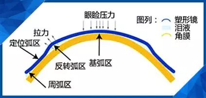 塑形镜的原理_△角膜塑形镜视力矫正原理