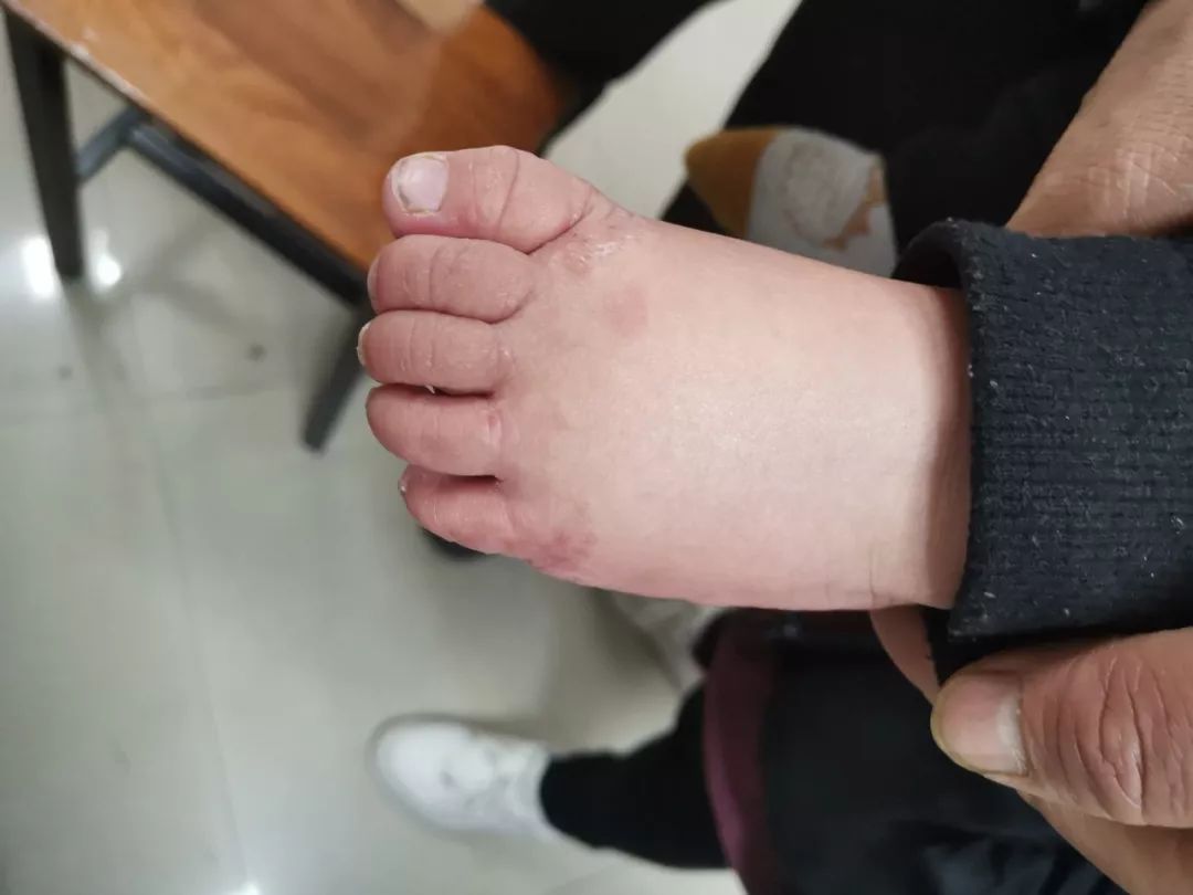 8个月的宝宝竟然得了"香港脚"!医生:梅雨季尤其要多注意