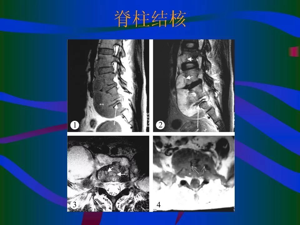 脊柱结核的ct及mri诊断 | 影像天地