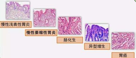 第一步:慢性浅表性胃炎