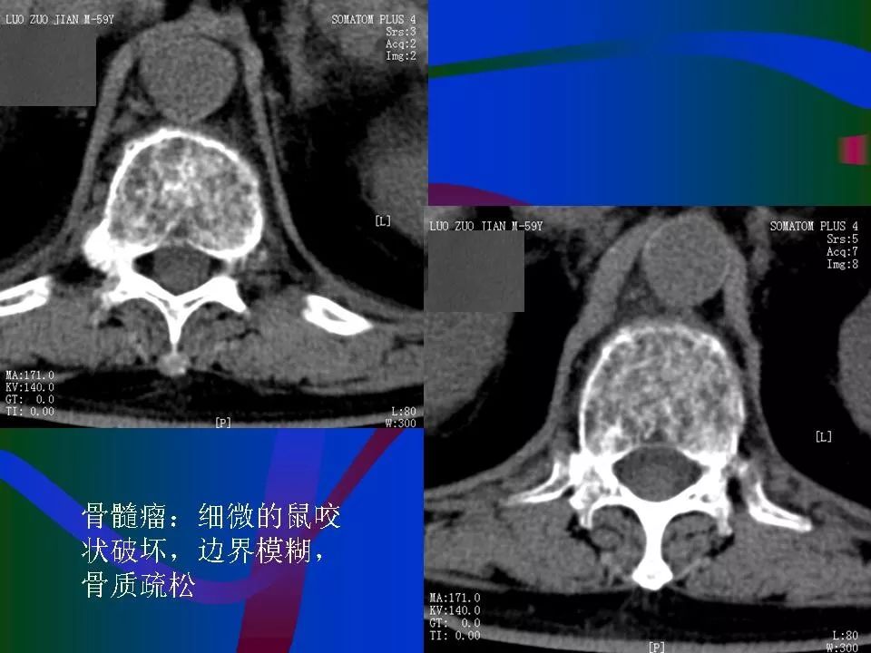 脊柱结核的ct及mri诊断 | 影像天地