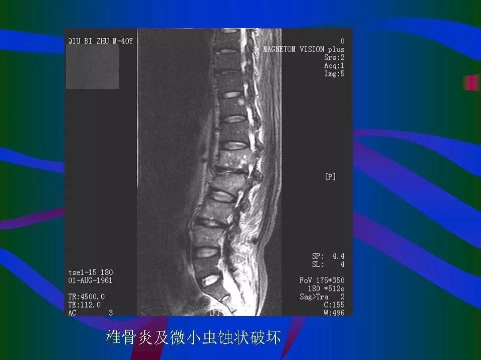 脊柱结核的ct及mri诊断 | 影像天地