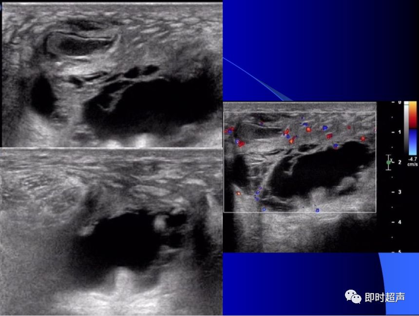 坐骨结节囊肿超声诊断