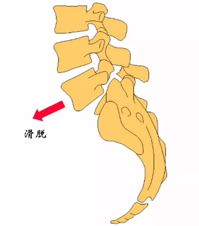 腰突的原理_白领司机腰突真的可以治愈么(2)