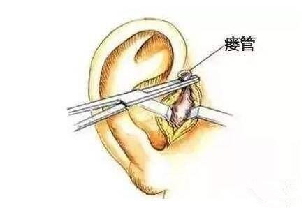                     孩子耳朵上有个小孔，宝妈好奇挤了一下，医生摇头：安排手术吧