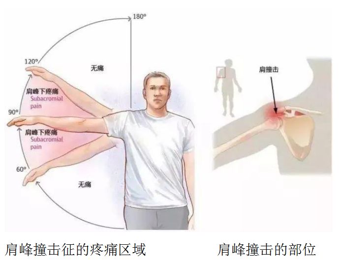 肩周炎痛是什么原理_肩周炎是哪个部位痛图
