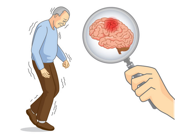 什么原因会引起脑梗发作 2e5a007d59854dedbb594e6110a1eb24.png