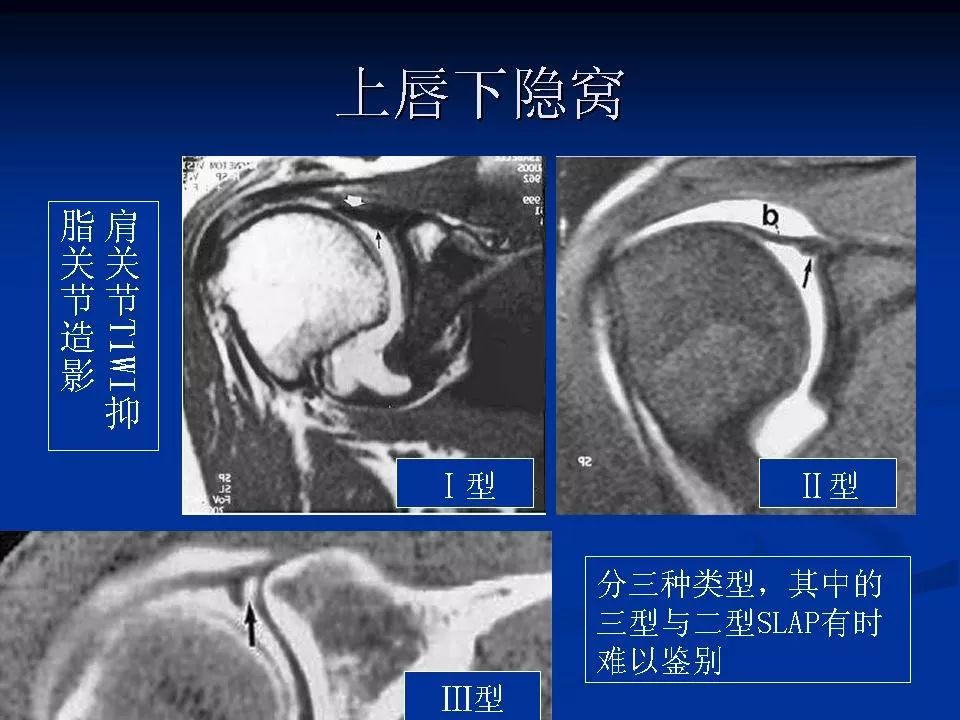 肩关节盂唇损伤的mri诊断影像天地