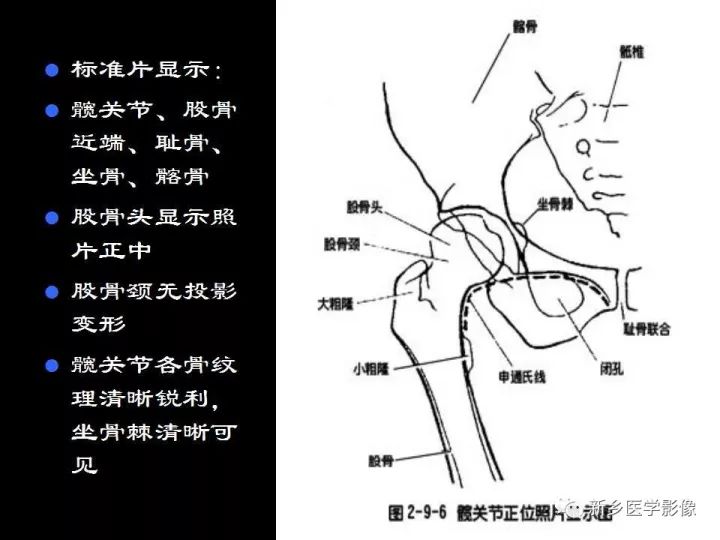 髋关节x线解剖摄影技术测量方法