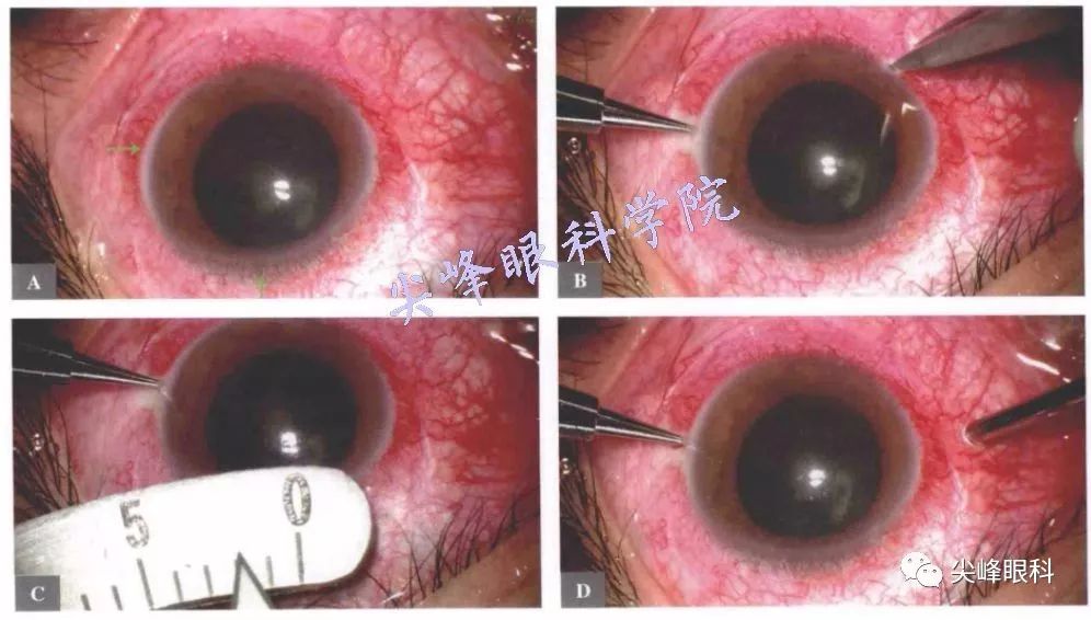 睫状体分泌功能减弱性手术part01图解青光眼手术操作与技巧061