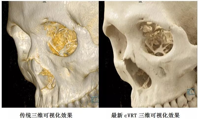 我所引进世界最先进ct应用新技术国内首家应用图像极度逼真