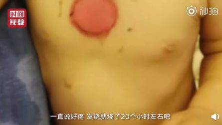                     烫人的网红三伏贴