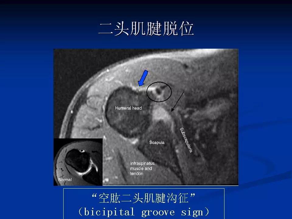 肩关节盂唇损伤的mri诊断影像天地