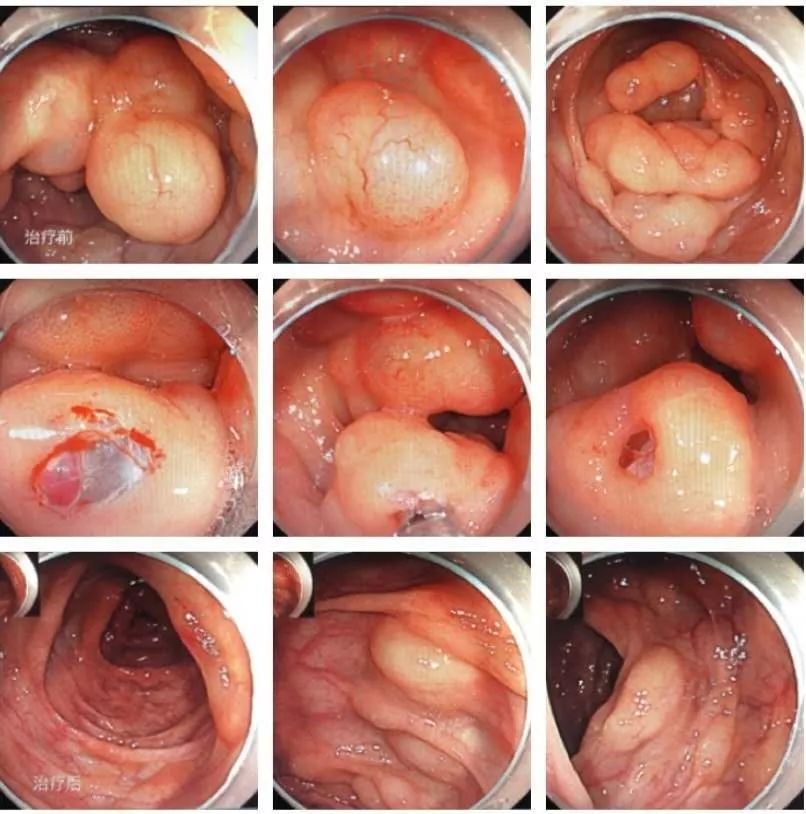 【三院·医疗现场】我院消化内科成功治疗一例临床罕见结肠气囊肿合并