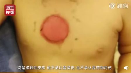                     烫人的网红三伏贴