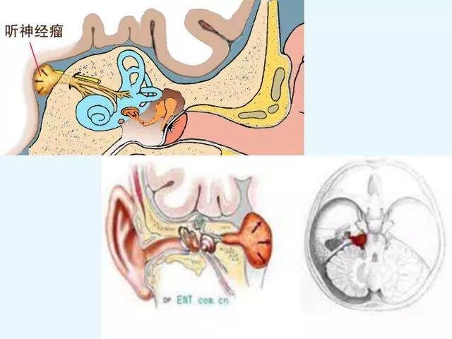 患者会出现头昏,眩晕,耳鸣,听力下降等前庭神经及耳蜗神经受损症状