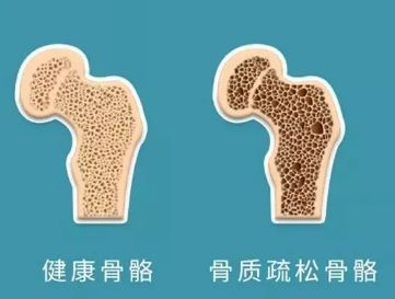 40秒自查骨盐量别让骨质疏松找上门