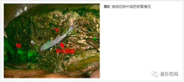 规范吲哚菁绿荧光引导腹腔镜解剖性肝脏Ⅵ段切除手术流程