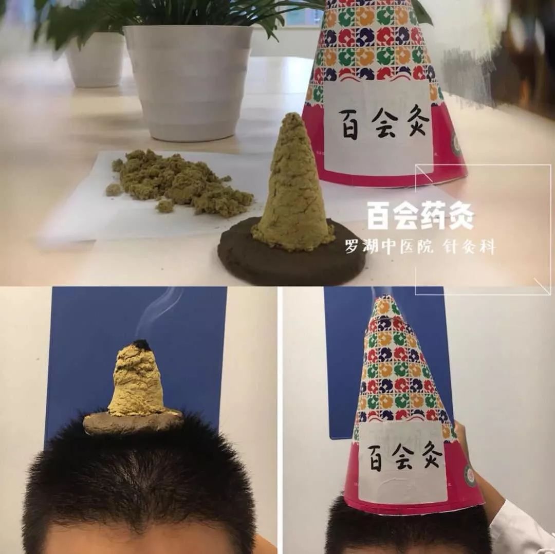 药铺灸脐灸火龙罐灸罗湖中医院邀请您体验各式灸法