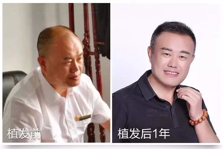年纪轻轻就脱发秃顶怎么办全省招募毛发缺失者可申请免费植发脱发秃顶