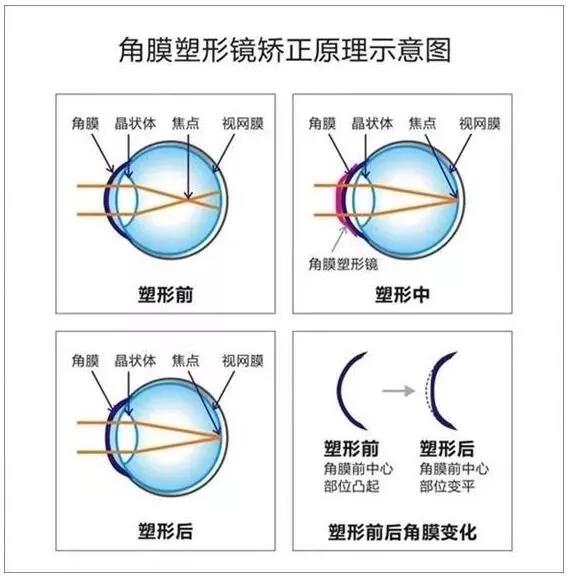 请问近视利用什么的原理制成的_预防近视手抄报(3)