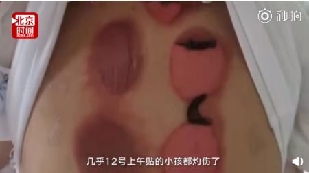                     烫人的网红三伏贴
