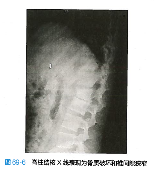 脊柱结核影像学表现特点为椎间隙变窄,相邻椎体骨质破坏,周围出现脓肿