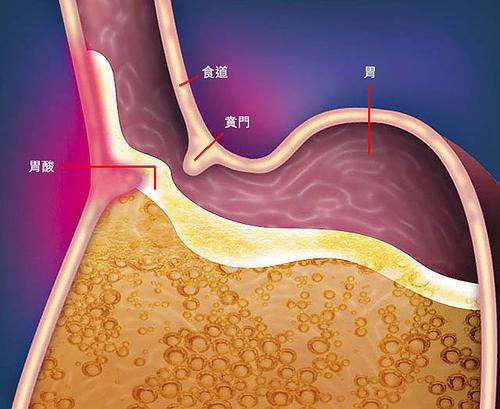 不同类型的胃食管反流病人用药大不相同.