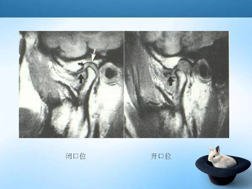 颞下颌关节紊乱mri表现 | 影像天地