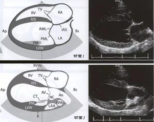 如下图所示,其中切面1为标准四腔心图像(右心室rv,右心房ra,左心房la