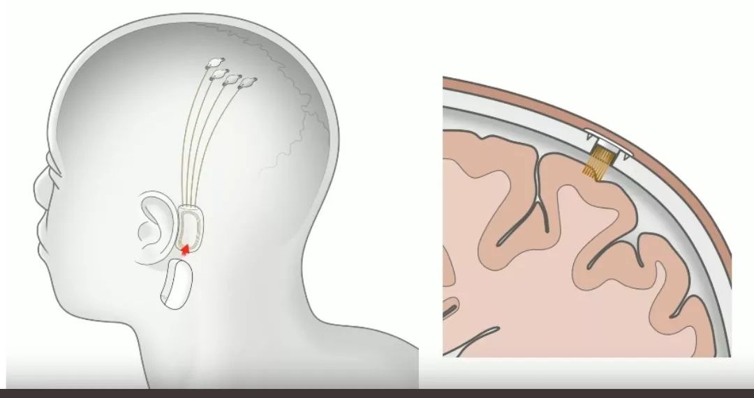 脑机接口植入方式 示意图