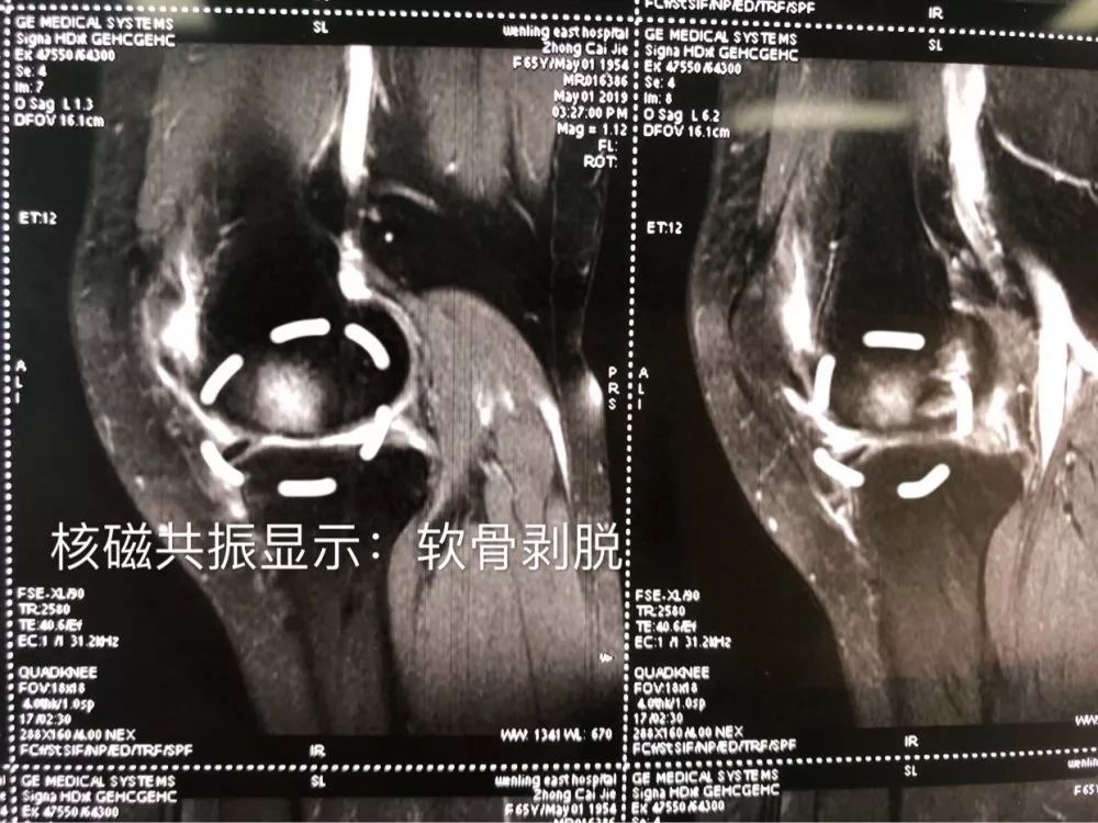 【技术看台】台州市中西医结合医院成功完成一例膝关节置换术! 日博娱乐官网
