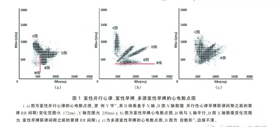 李方洁老师散点图系列之二十二:"倒y字"心电散点图与hrv 及心血管疾病