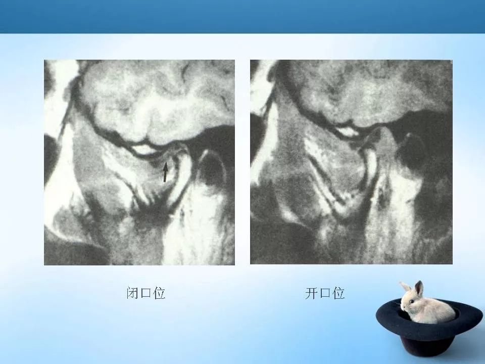 颞下颌关节紊乱mri表现 | 影像天地