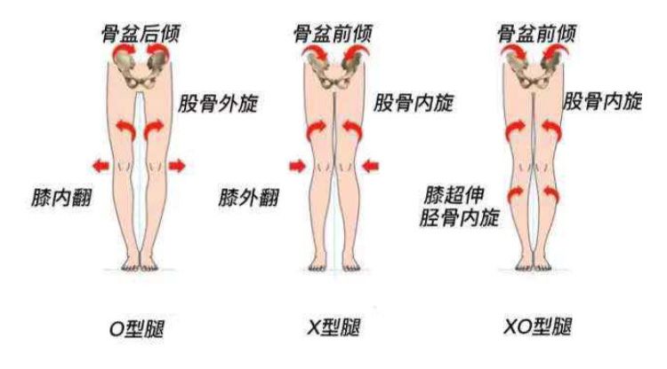 骨盆前倾导致的假胯宽,不仅 显胖,还会显得腿又粗又短.