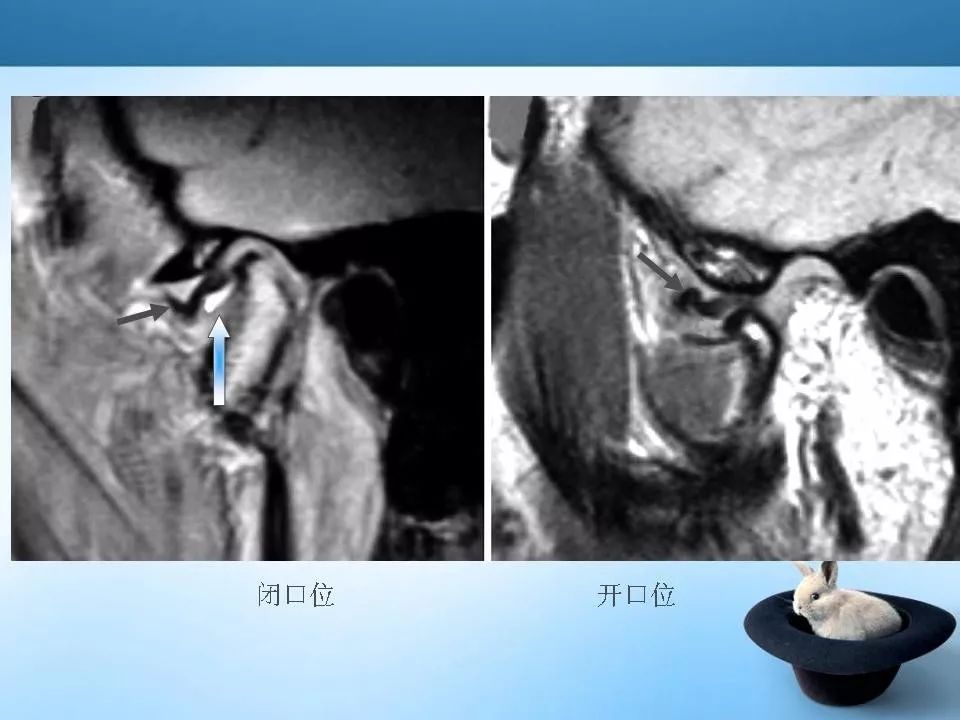颞下颌关节紊乱mri表现 | 影像天地