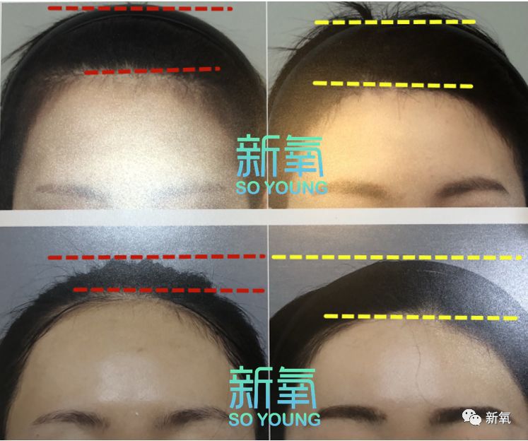 如何变高颅顶 7895c30533ac46498c240b1a3b09b317.jpeg