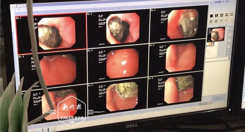                     哈尔滨9岁女孩肚子疼，一查连医生都吓一跳，她胃里有团直径18cm的头发！