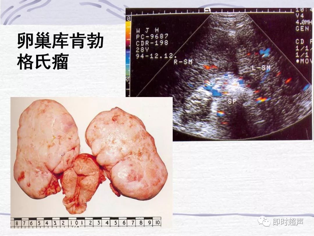 卵巢肿瘤的超声诊断