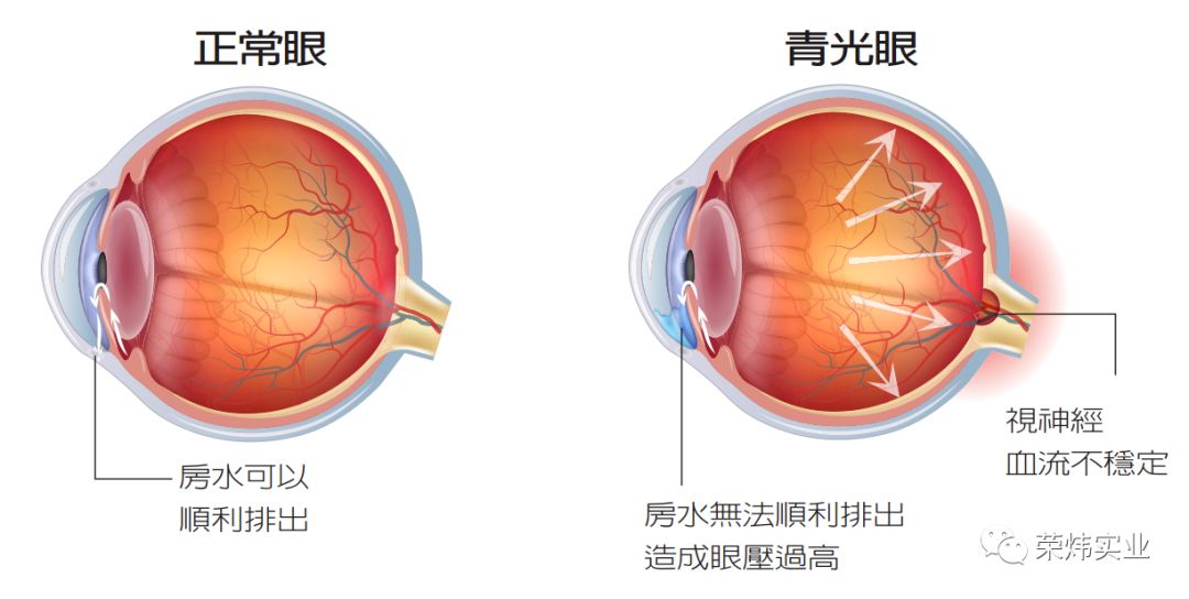 荣炜集团健康提示:青光眼的4大诱因