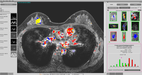 首个获FDA 批准的AI 乳腺癌诊断系统诞生：能降低39% 漏诊率_QuantX