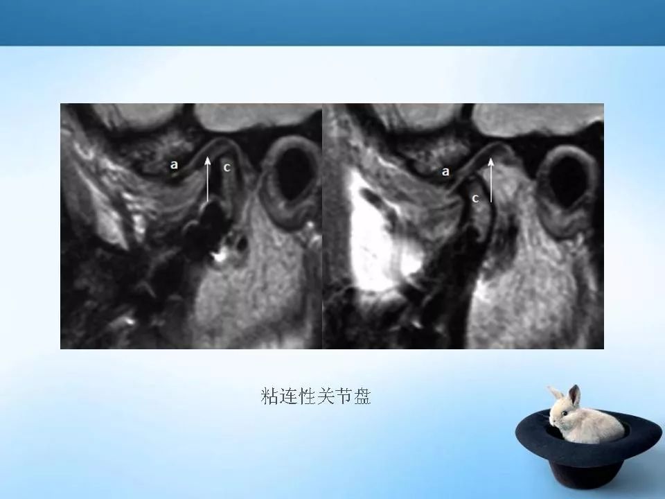 颞下颌关节紊乱mri表现影像天地