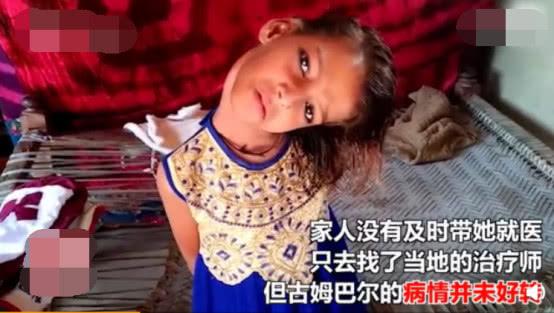                     11岁女孩脖子向左扭曲90度，竟因小时候跌倒，家人没重视