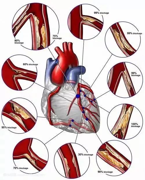 【护心课堂】心脏的冠状动脉——"水管"_心血管