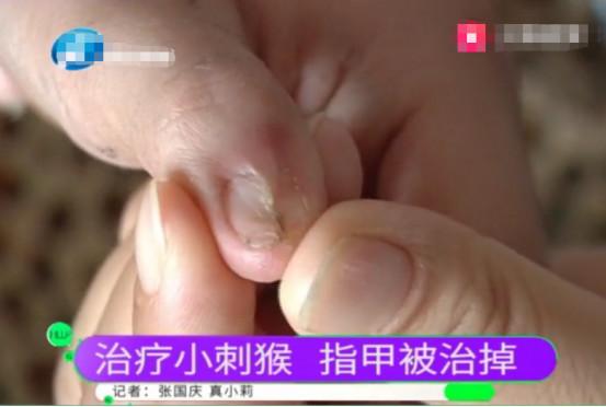                     医德缺失！内科医生治外科皮肤病，导致8岁男童甲床坏死